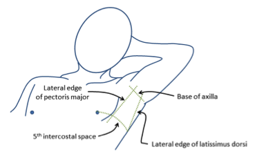 ICD Insertion (Intercostal Drain)