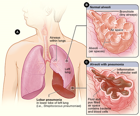Pneumonia & Respiratory Infections