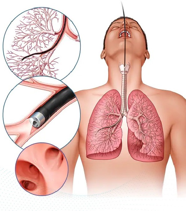 Cryobiopsy & Sampling