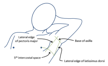 ICD Insertion (Intercostal Drain)